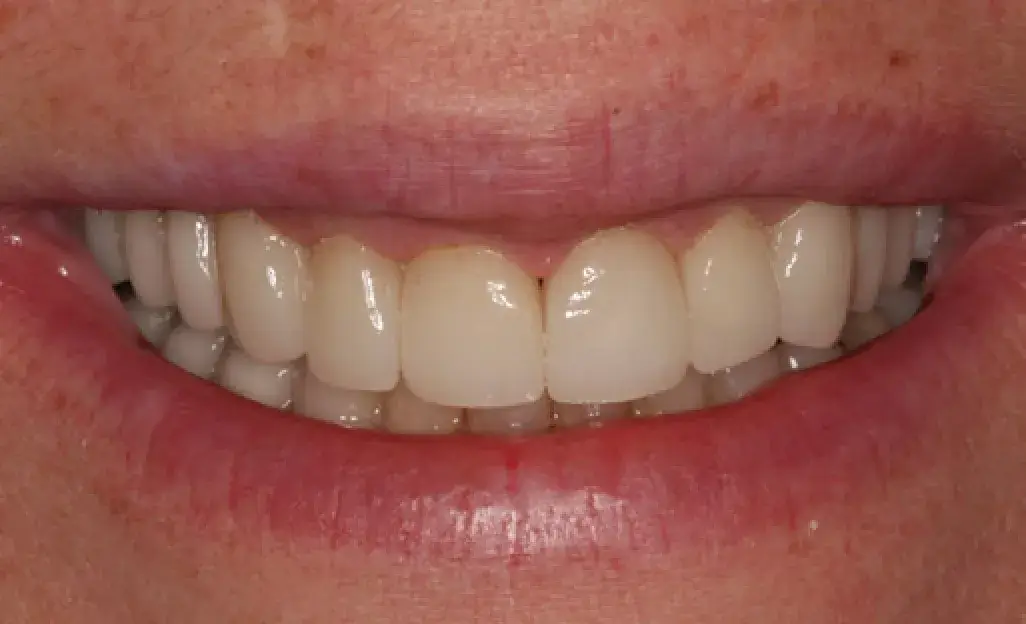 A close-up of a smiling person's mouth showing healthy, straight teeth.