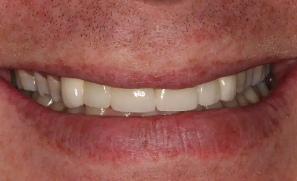 A close-up of a person's mouth showing a slight smile with straight, clean teeth.