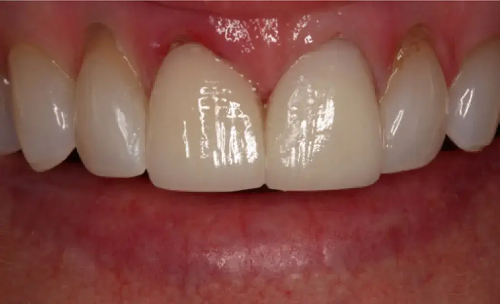 Close-up of six straight, white teeth with visible gums.