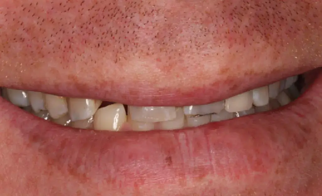 A close-up of a person’s smile showing chipped front teeth.
