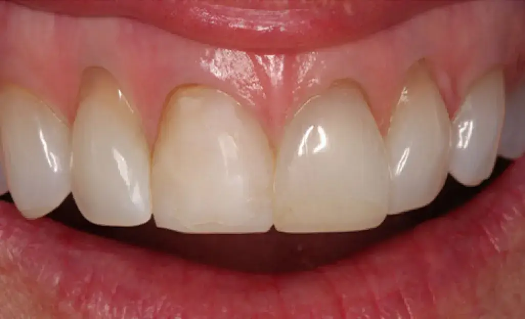 A close-up of a person's teeth showing a wide smile.
