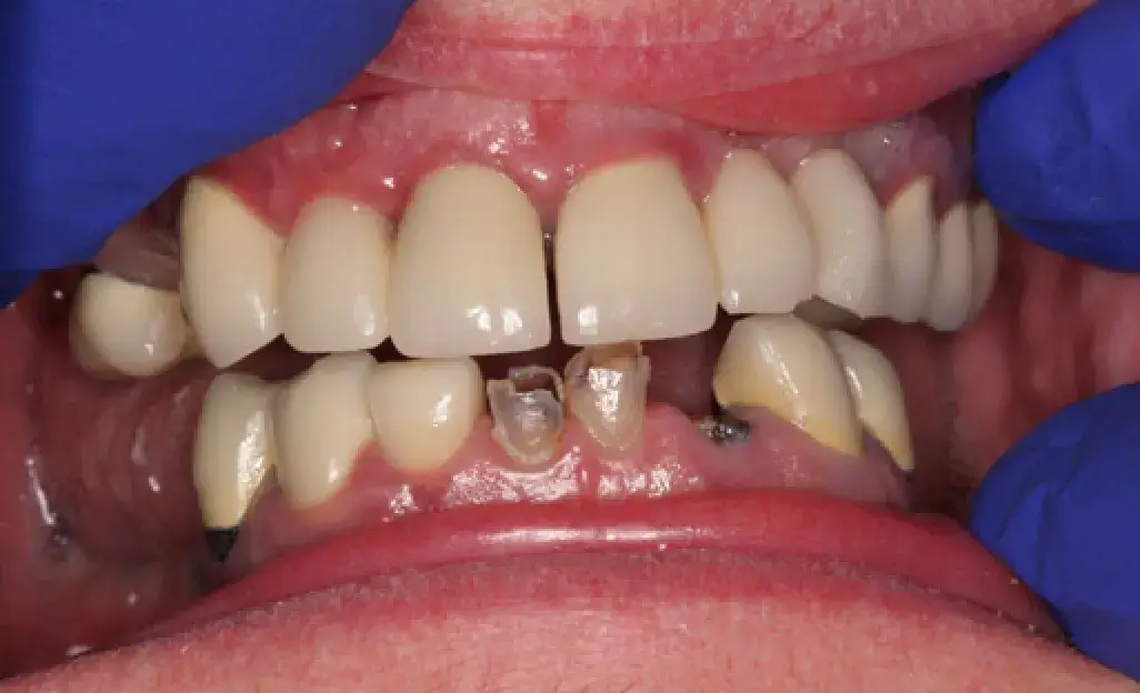 A close-up of a person's mouth showing dental implants and missing teeth.