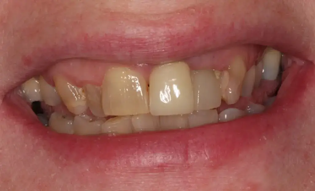 A close-up of a person's mouth showing uneven and discolored teeth.
