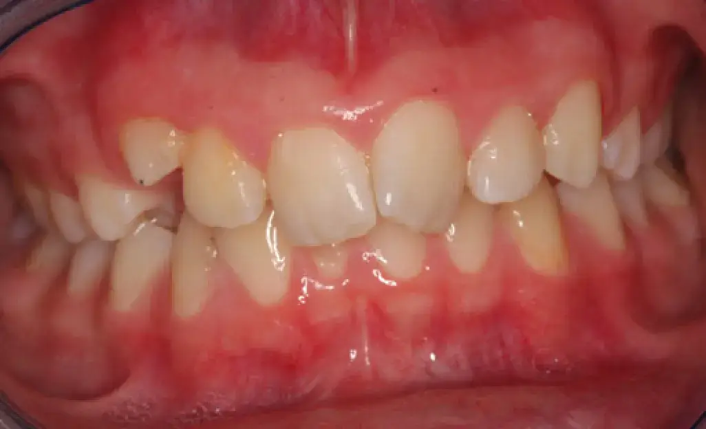 Close-up of a person's misaligned teeth and gums, showing noticeable crowding and irregular positioning.