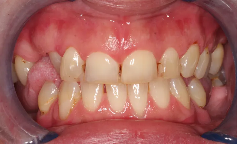 Close-up of a person's open mouth showing teeth and gums clearly.