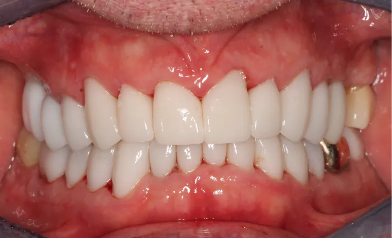 Close-up of a person's mouth showing two rows of white, evenly aligned false teeth.