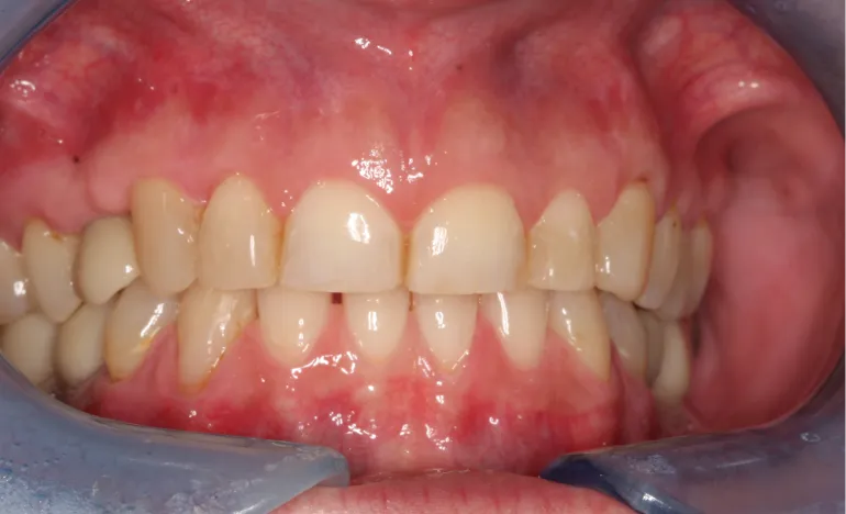 Close-up of a person's open mouth showing teeth and gums in a dental examination setting.