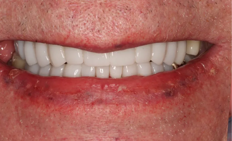 Close-up of a person’s mouth showing white, straight dental implants and red, irritated lips.